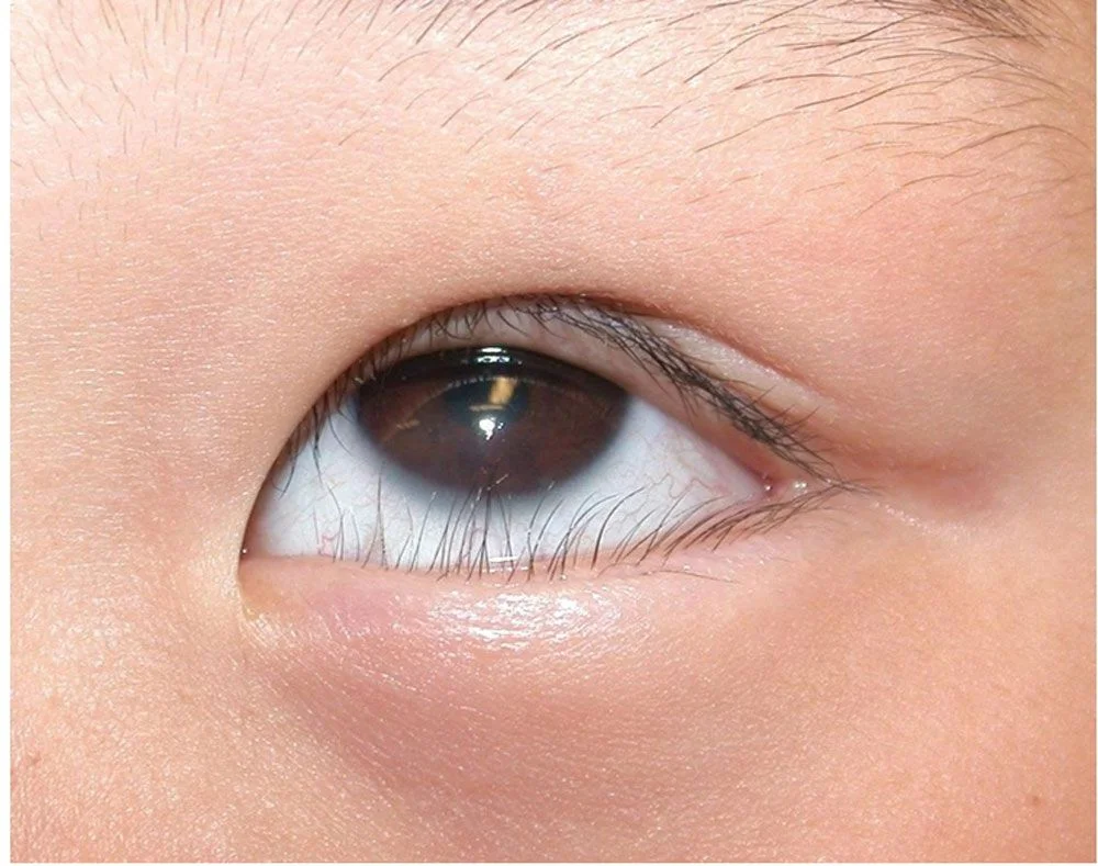 XỬ LÝ QUẶM MI BẨM SINH