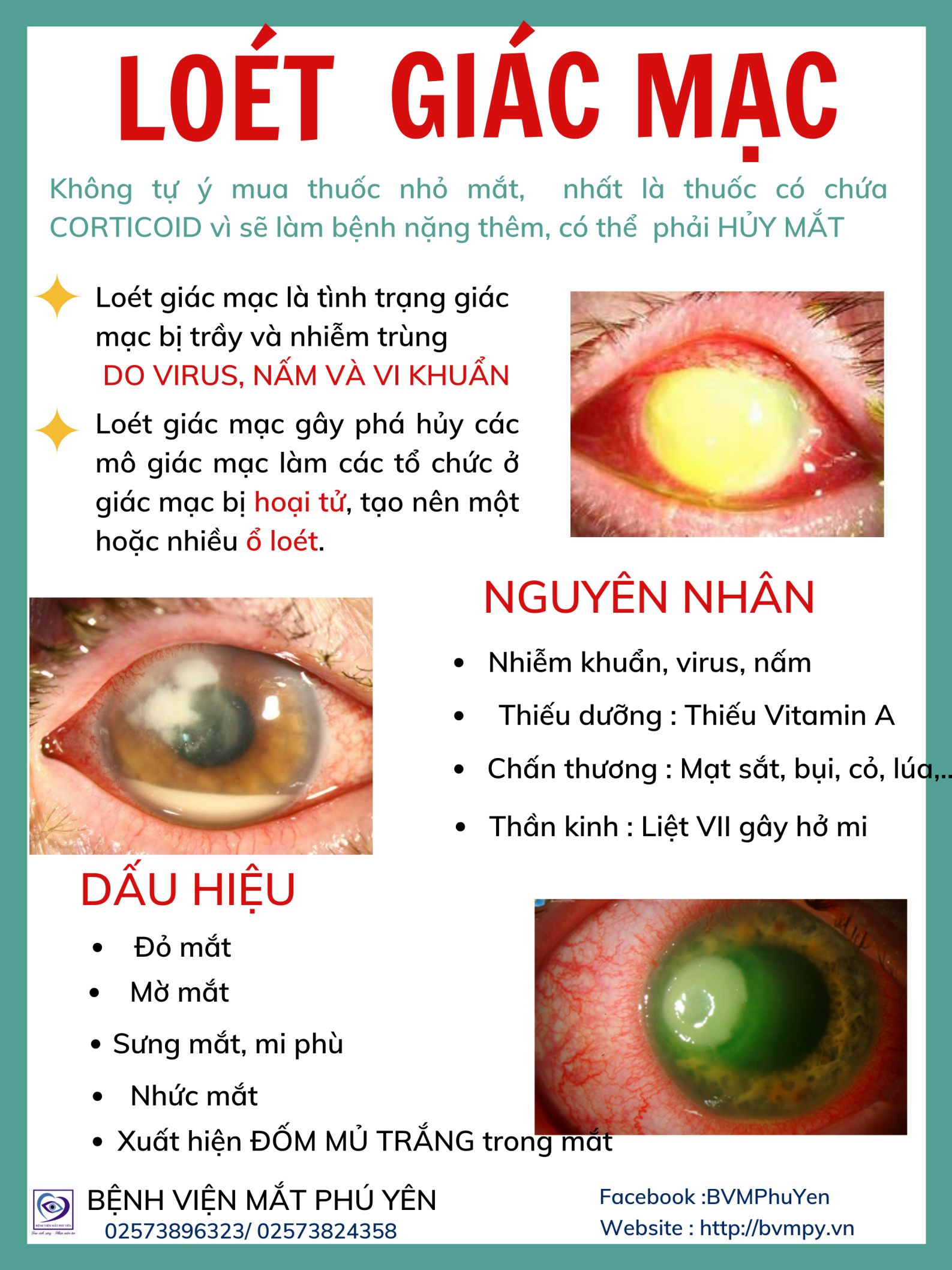 Loét giác mạc